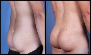 SmartLipo Brazilian Butt Lift