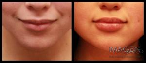 Silk lip augmentation filler