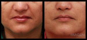 Restylane HA fillers