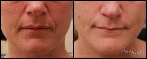 Sculptra Facial Fillers