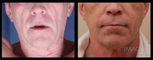 Facial Fat Transfer