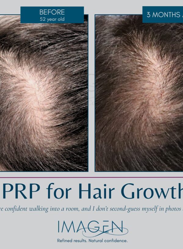 Hair Restoration Omaha