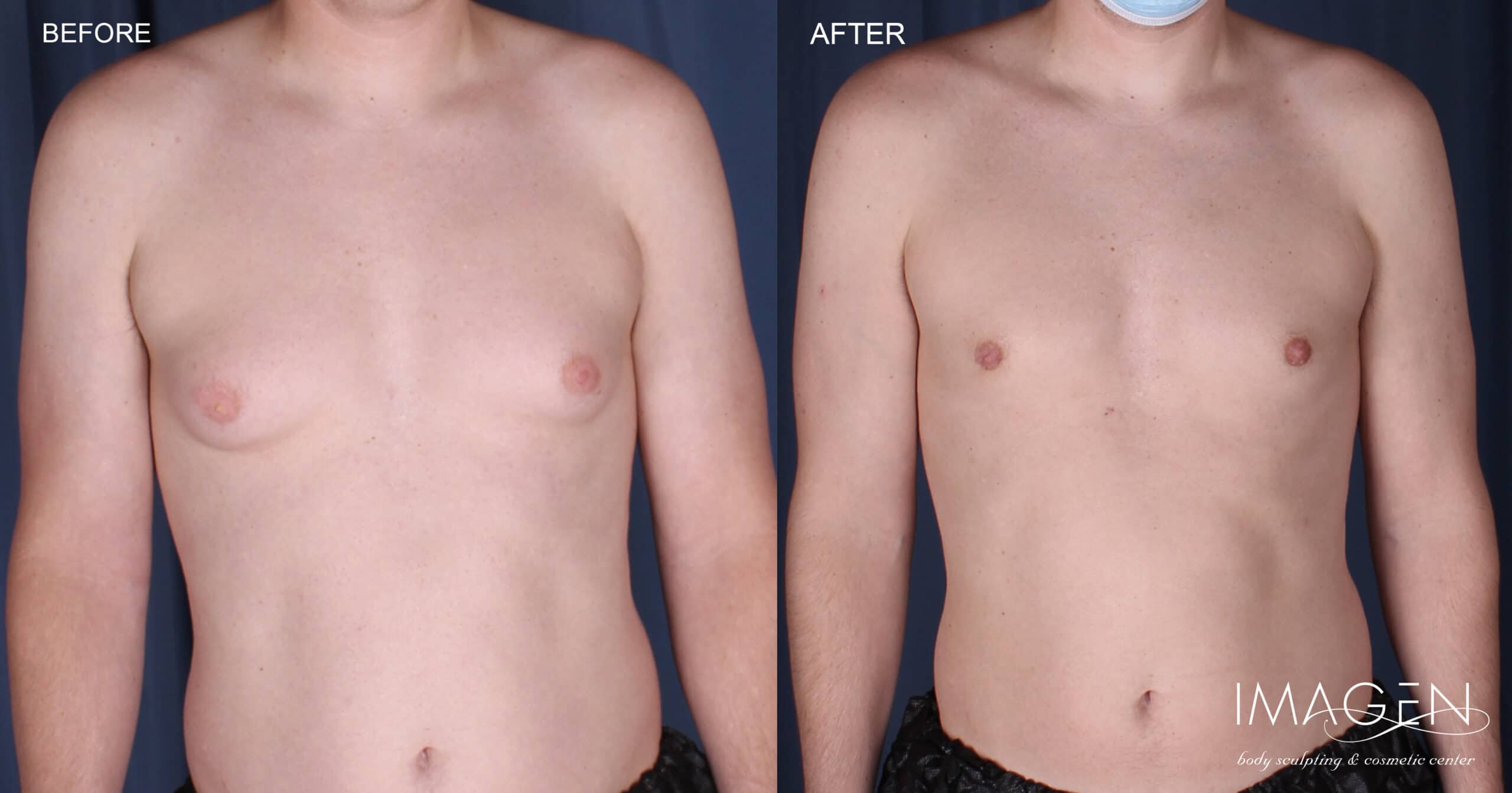 Omaha NE Gynecomastia Breast Reduction Laser Liposuction Imagen Surgery3