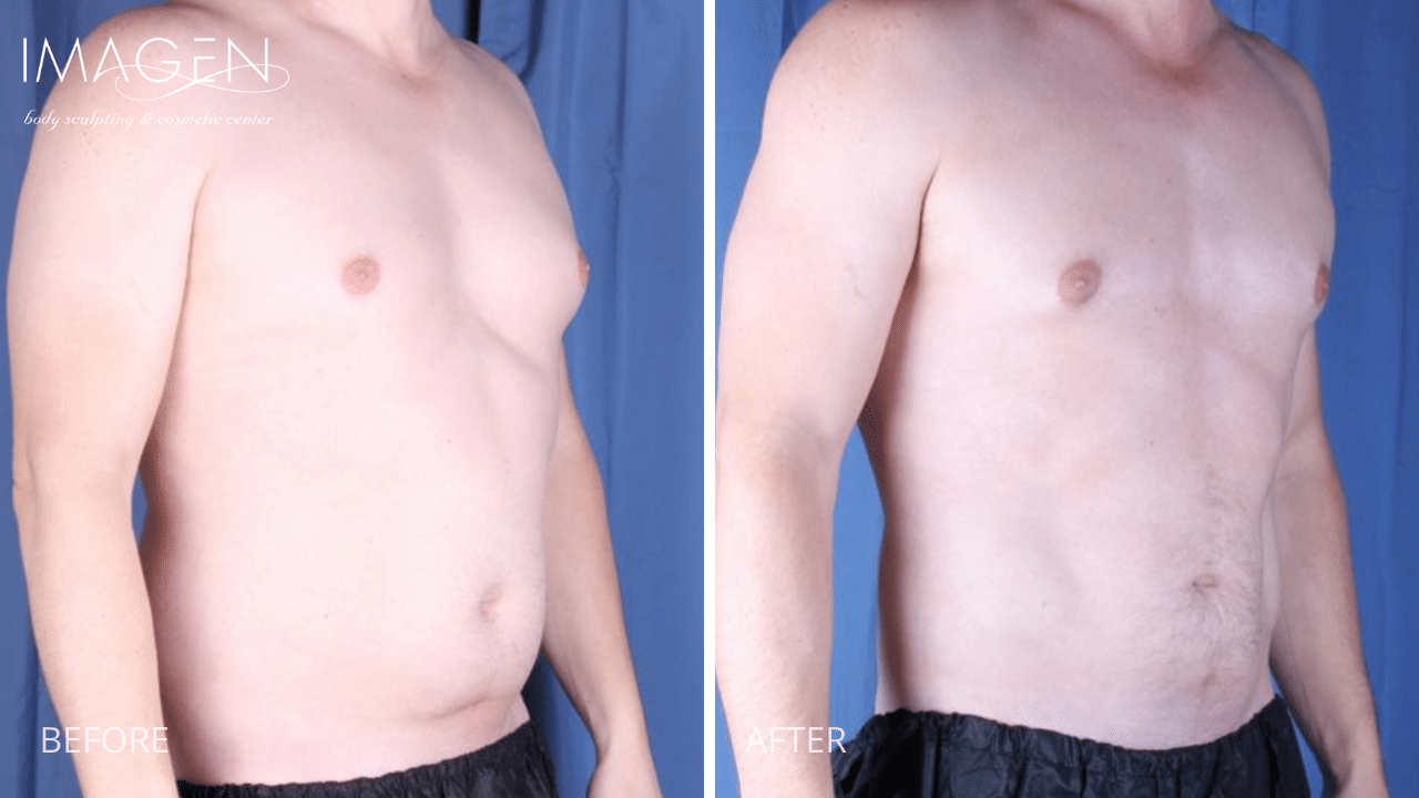 Lipo 360 + Gynecomastia