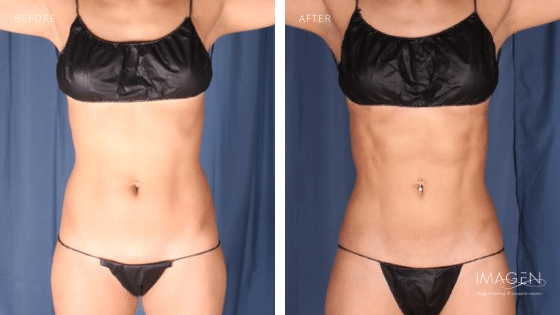 Muscle Etching 4D Hi-Def