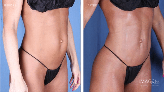 4D Hi-Def Muscle Etching