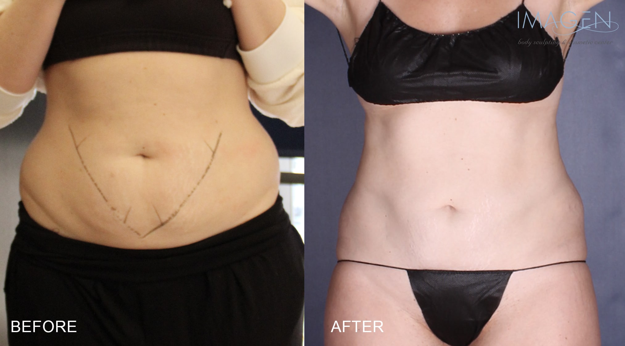 BA-NM-CS-Abdomen before and after CoolSculpting Omaha