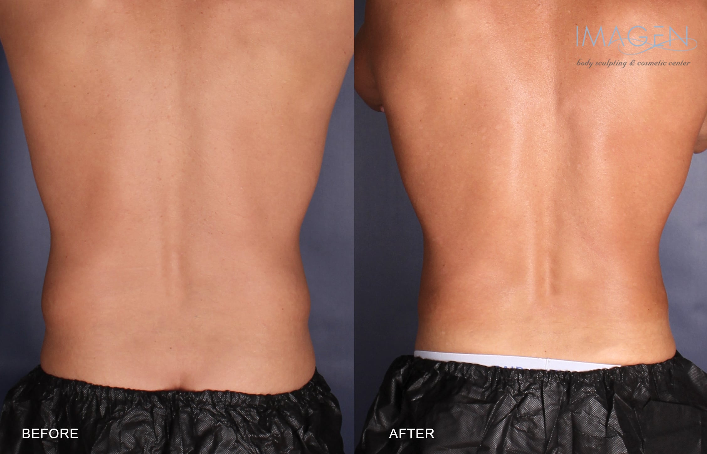 CS-KR-Flanks before and after CoolSculpting Omaha