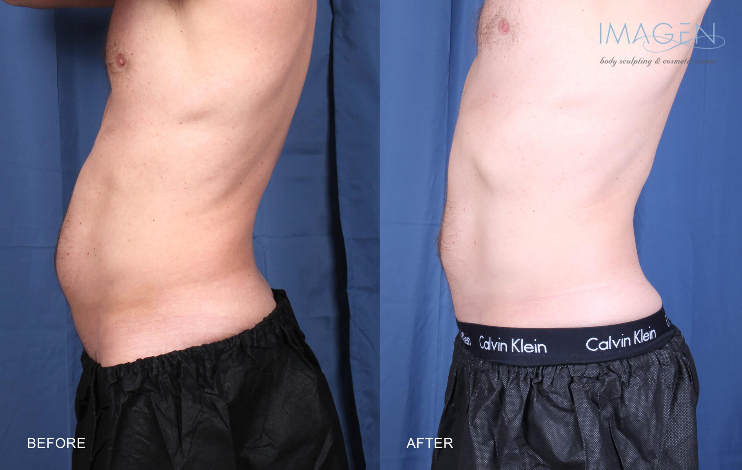 KB-BA-CS-Abdomen before and after CoolSculpting Omaha