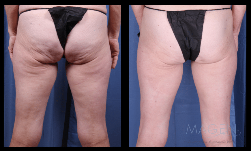 CZ 5 before and after cellulite treatment omaha