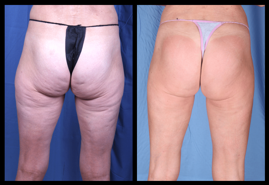 CZ 7 before and after cellulite treatment omaha