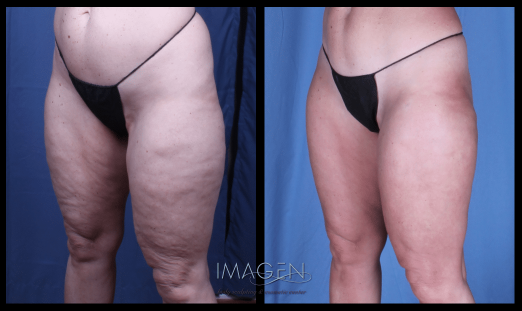 CZ before and after cellulite treatment omaha