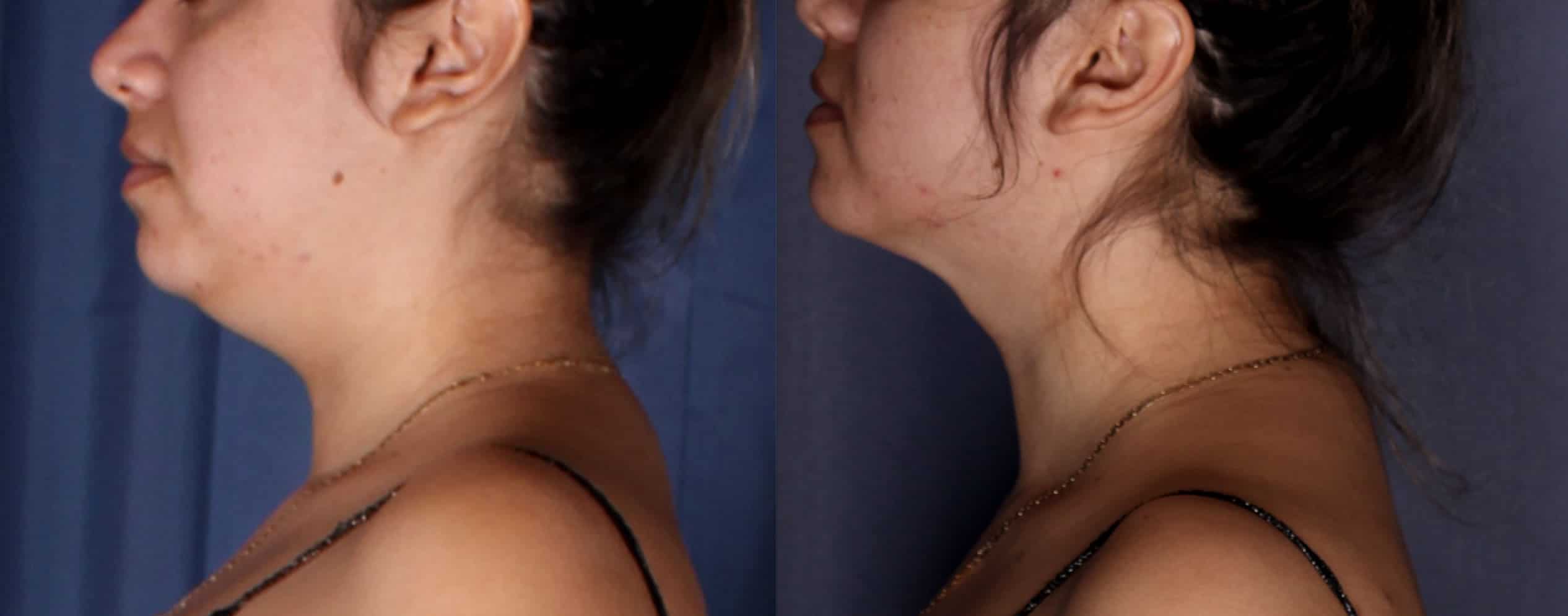 neck-before-and-after