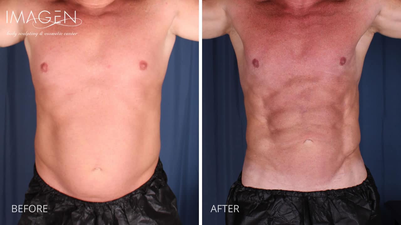14-1 Man with vaser liposuction hi def