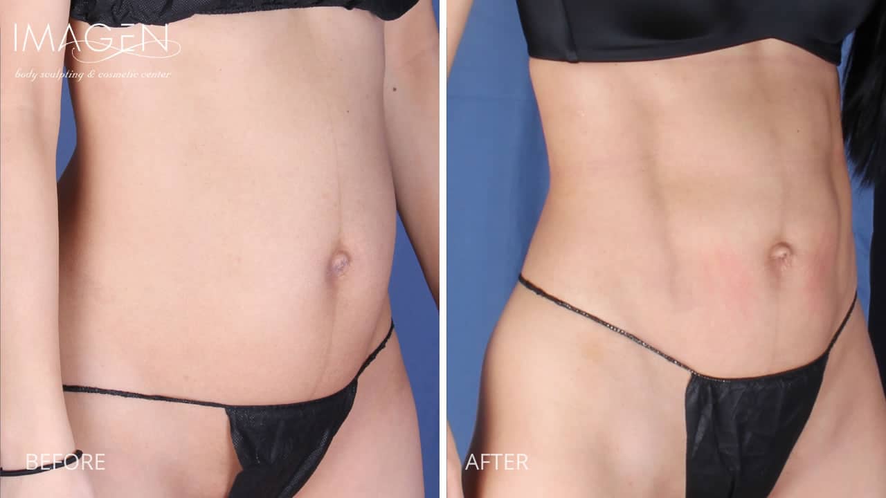 15 Woman's Hi Definition Liposuction