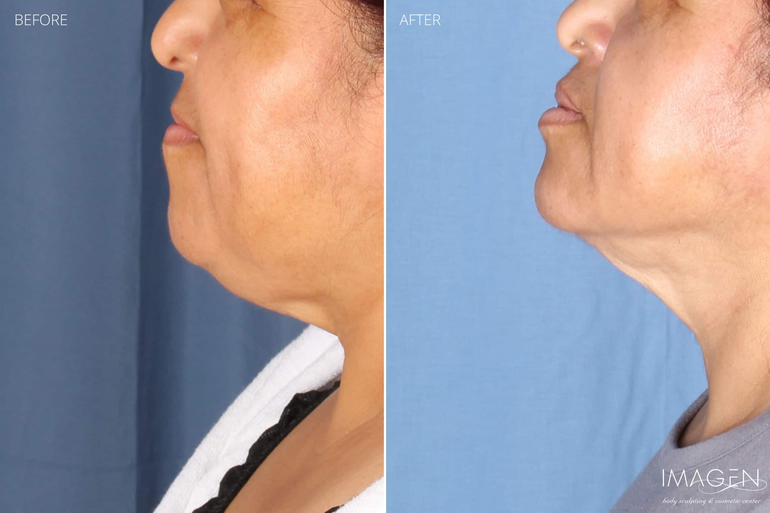 3 Before and After SmartLipo Chin