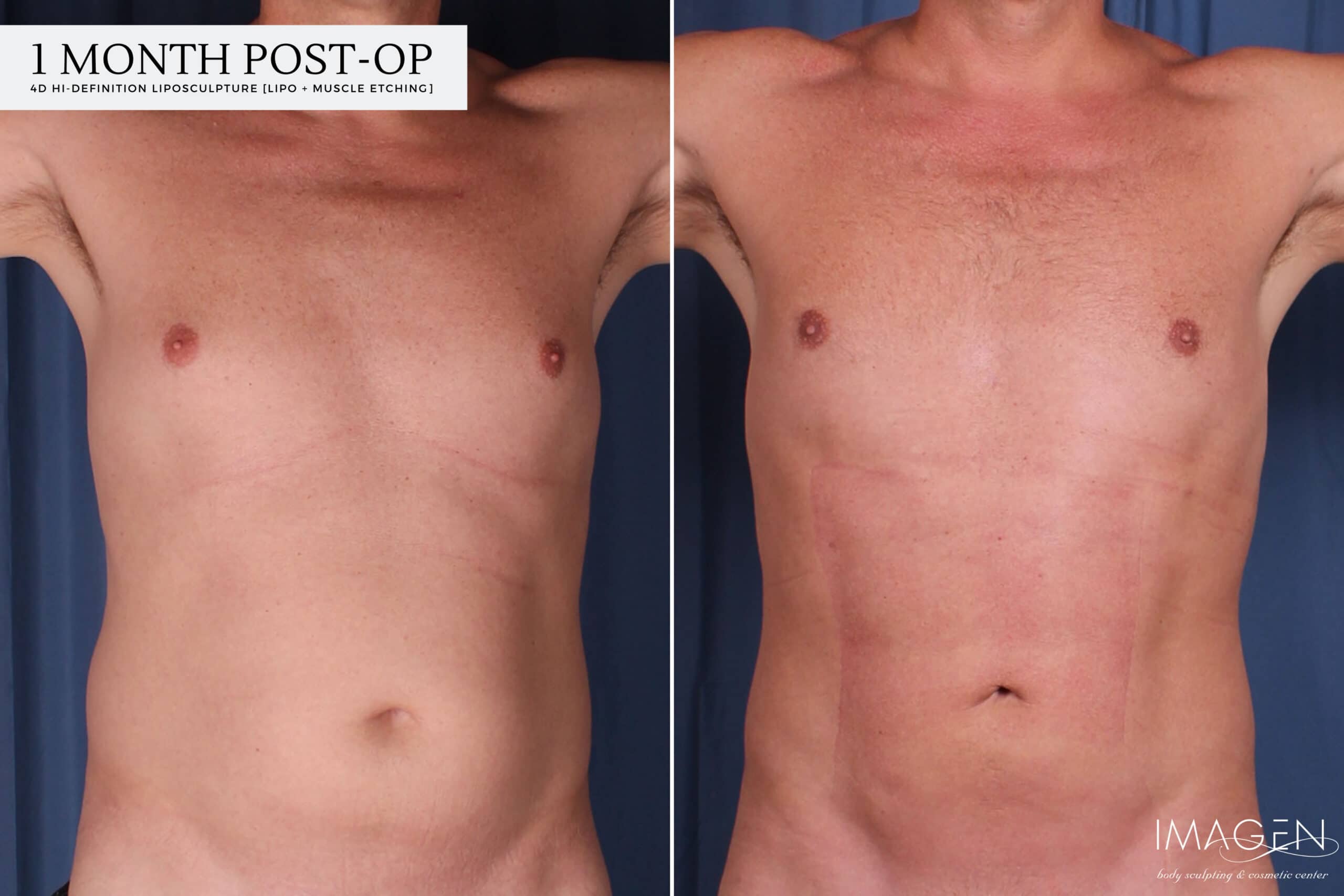 hd 1month 4D Hi-Definition Liposuction