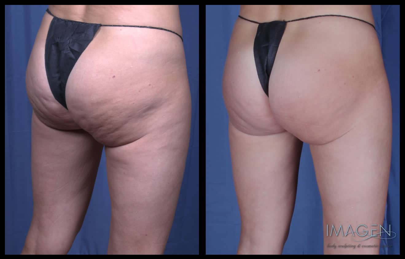 CZ-1 before and after cellulite treatment omaha