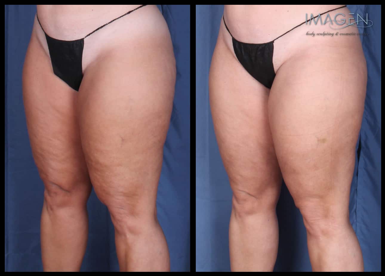 CZ-2 before and after cellulite treatment omaha