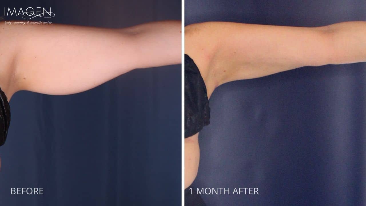 Omaha Body Sculpting Cosmetic Surgery Arms Liposuction 2
