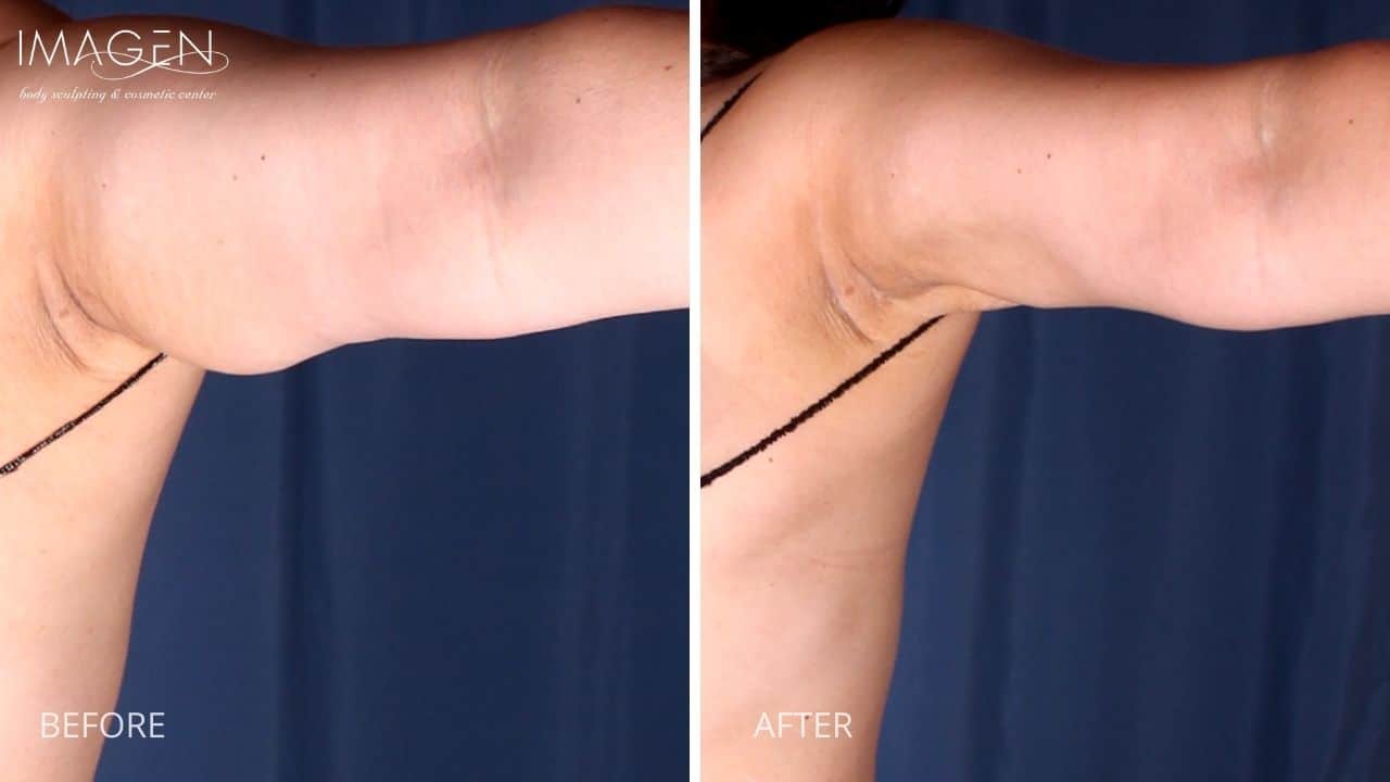 Omaha Body Sculpting Cosmetic Surgery Arms Liposuction 2