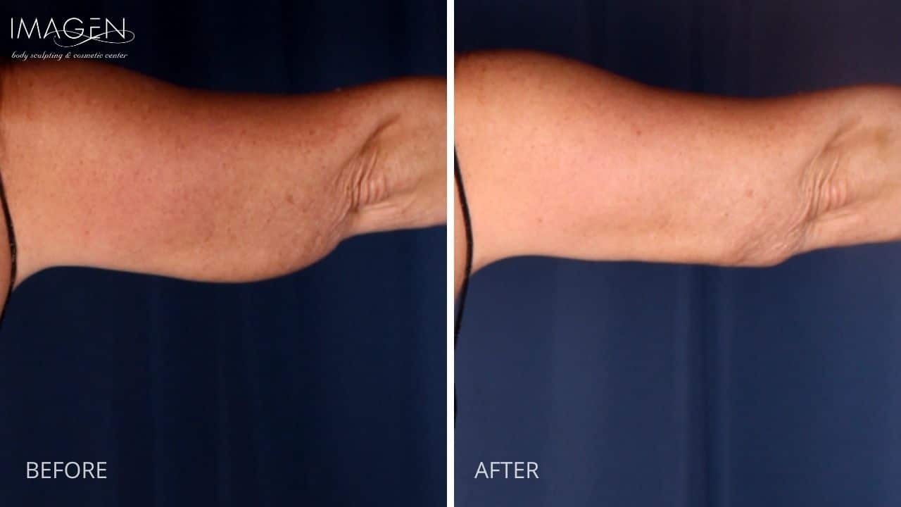 Omaha Body Sculpting Cosmetic Surgery Arms Liposuction 2
