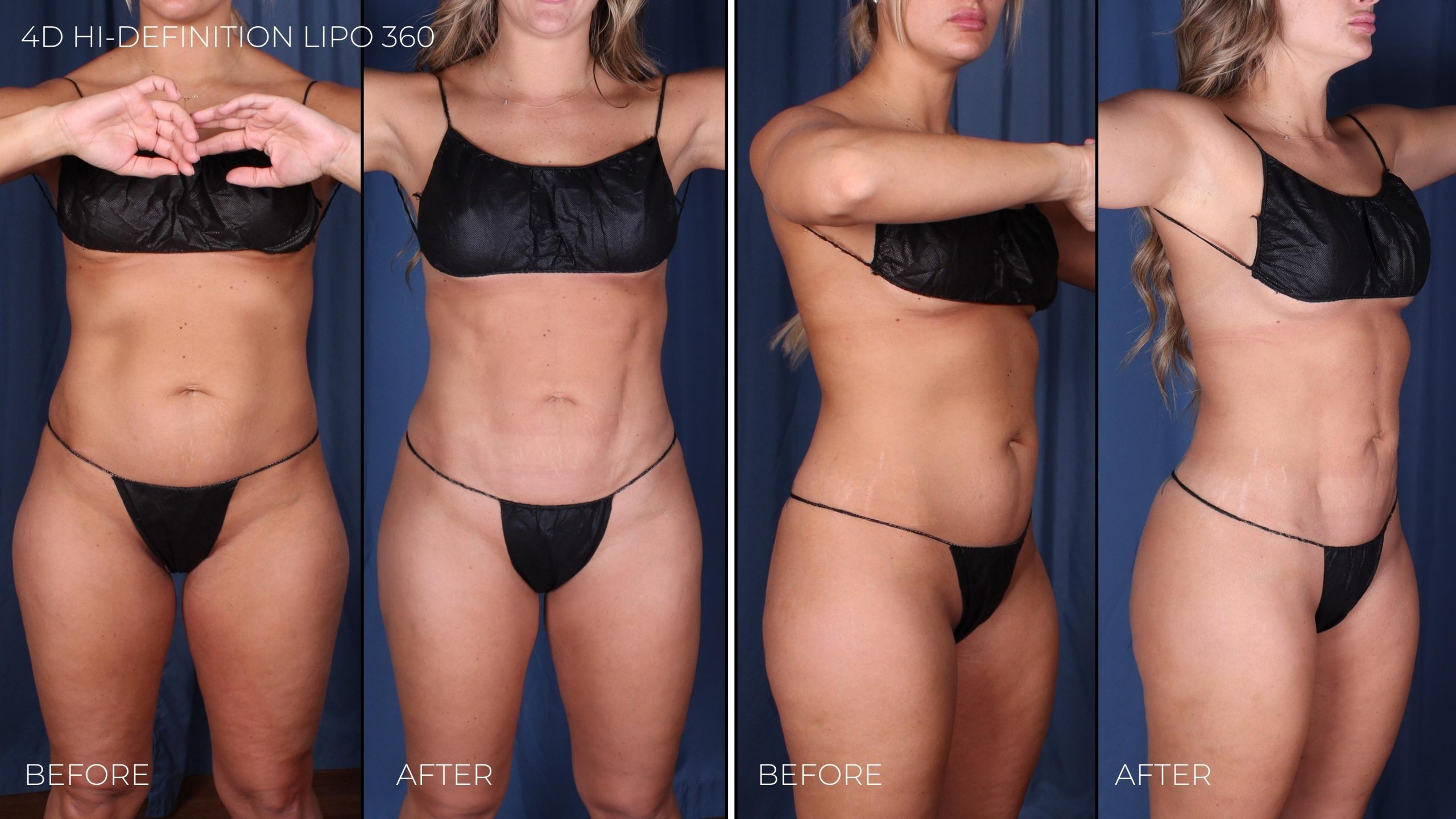 BEFORE:AFTER 4D Hi-Definition Liposuction 360 (2)