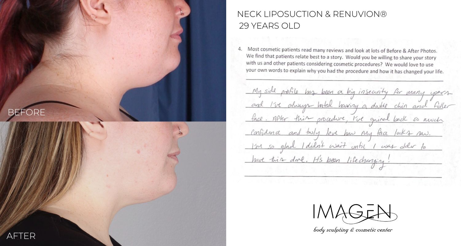 2023 Omaha Cosmetic Surgery Imagen Body Sculpting Neck double chin lipo Sono bello Nebraska liposuction neck chin renuvion omaha nebraska