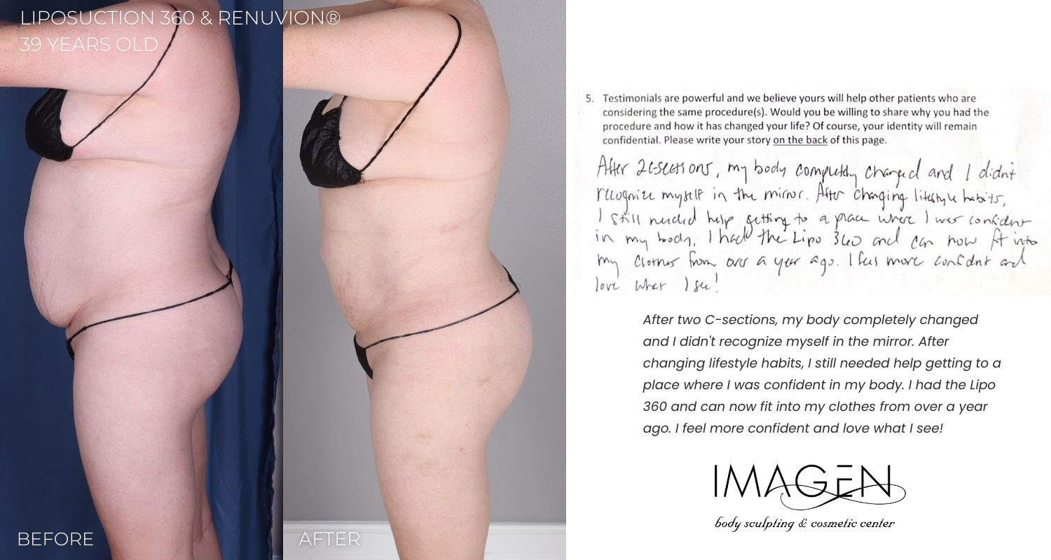 2023 Omaha Cosmetic Surgery Imagen Body Sculpting lipo 360 liposuction 360 renuvion omaha nebraska