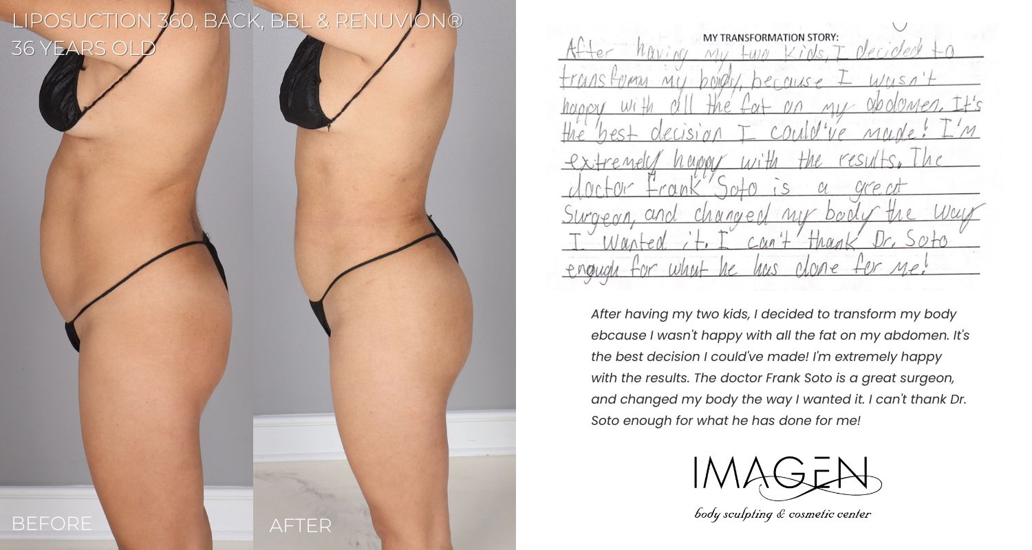 2023 Omaha Cosmetic Surgery Imagen Body Sculpting lipo 360 laser Sono bello Nebraska BBL Fat transfer butt lift liposuction 360 back bbl renuvion omaha nebraska