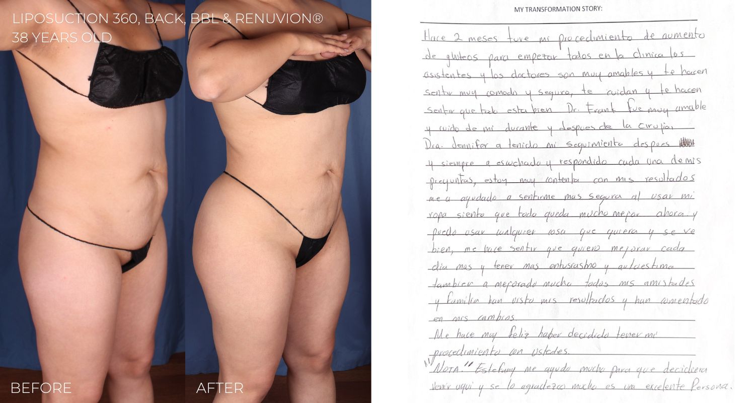 2023 Omaha Cosmetic Surgery Imagen Body Sculpting lipo 360 laser Sono bello Nebraska1 liposuction 360 back bbl renuvion omaha nebraska