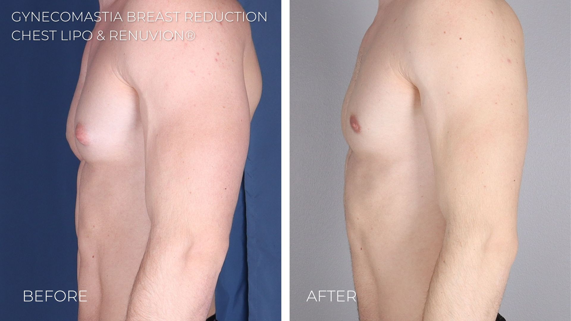 Omaha NE Gynecomastia Breast Reduction Laser Liposuction Imagen Surgery3