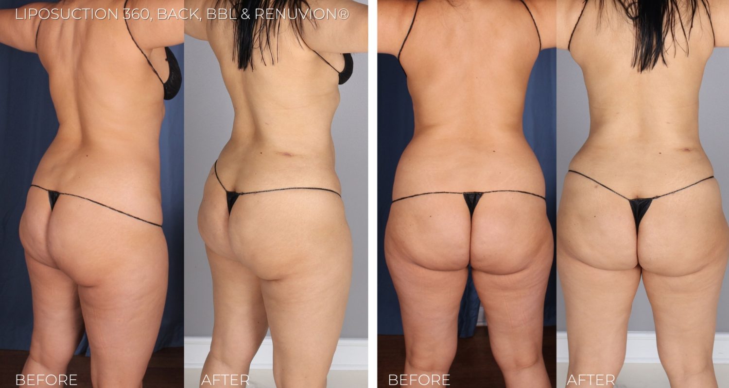 Imagen Omaha SL stomach back and BBL copy 1 SmartLipo 360 & Renuvion® Skin Tightening by Imagen Body Sculpting & Cosmetic Center