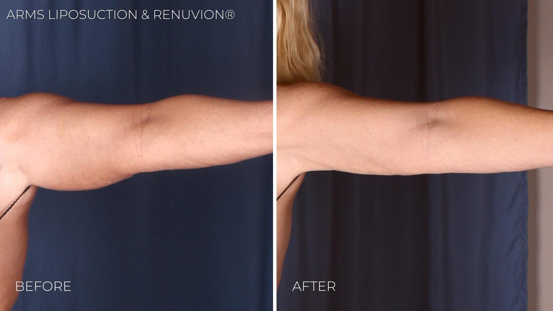 Omaha Body Sculpting Cosmetic Surgery Arms Liposuction 2