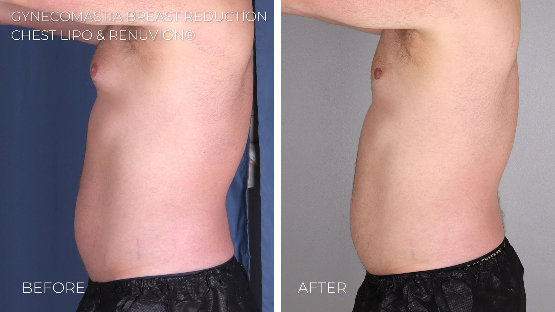 Omaha NE Gynecomastia Breast Reduction Laser Liposuction Imagen Surgery3