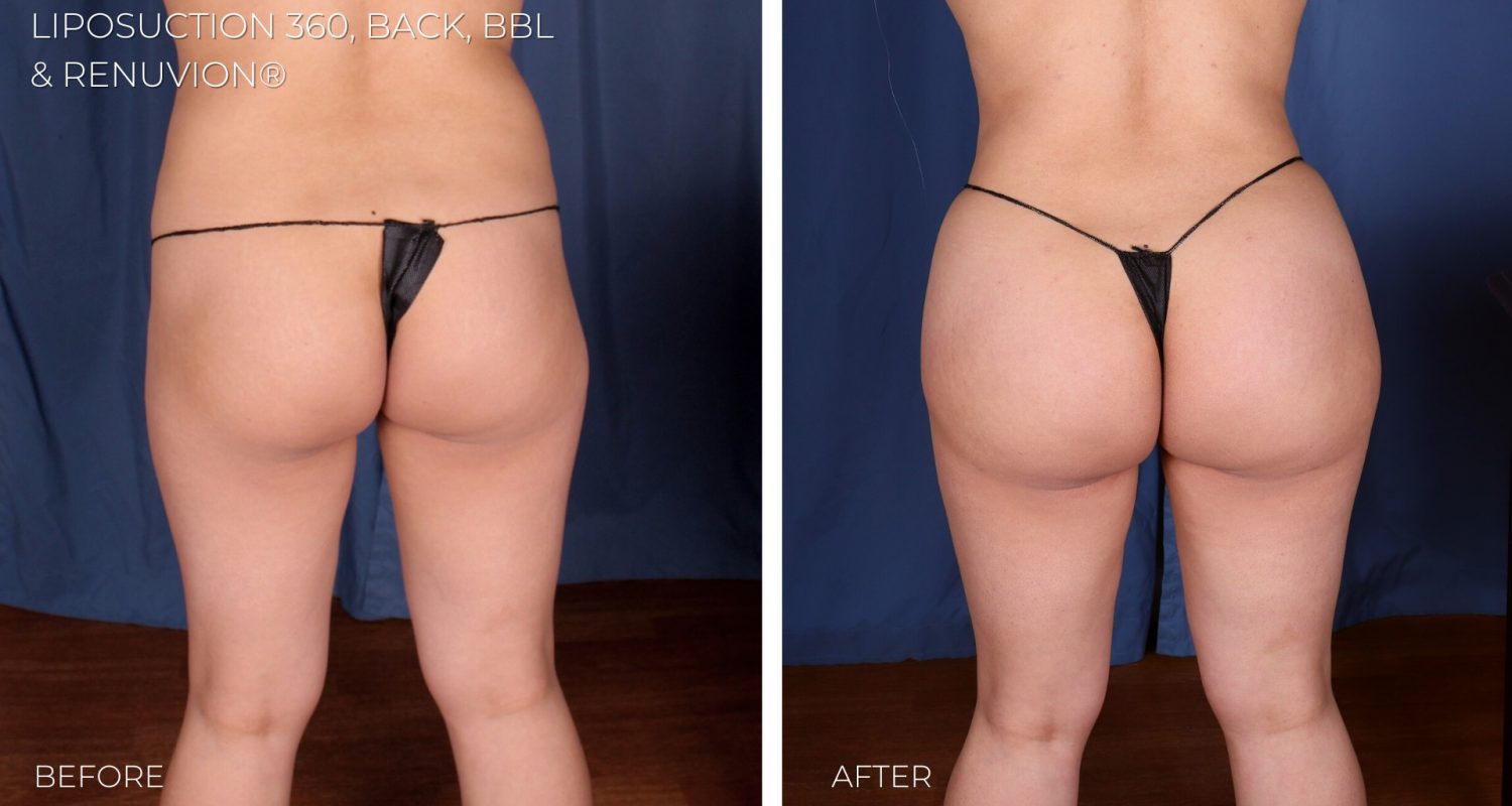 Omaha NE Imagen Body Sculpting SL 360 and Back curves body womens3 SmartLipo 360 & Renuvion® Skin Tightening by Imagen Body Sculpting & Cosmetic Center