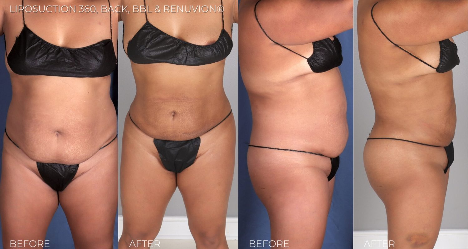 SmartLipo 360 & Renuvion® Skin Tightening by Imagen Body Sculpting & Cosmetic Center copy4 copy SmartLipo 360 & Renuvion® Skin Tightening by Imagen Body Sculpting & Cosmetic Center copy1 copy