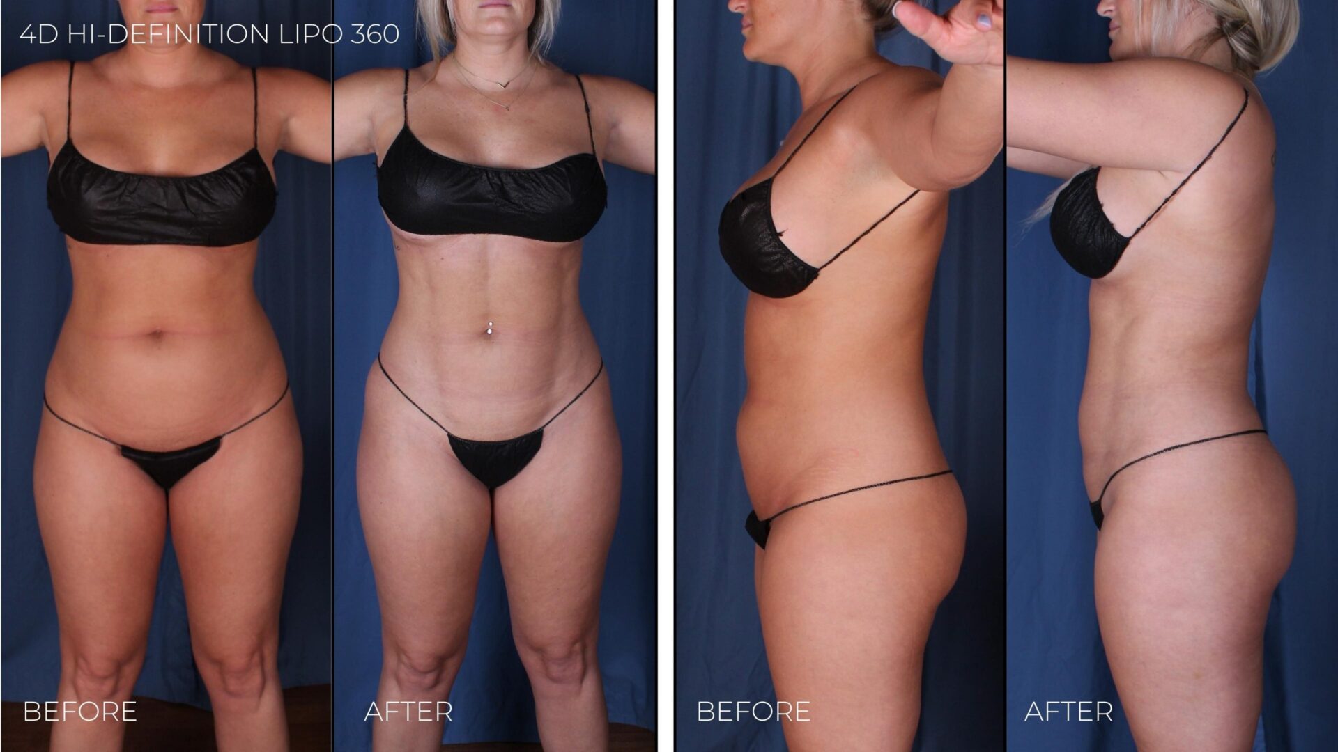 BEFOREAFTER-4D-Hi-Definition-Liposuction-360-scaled (1)