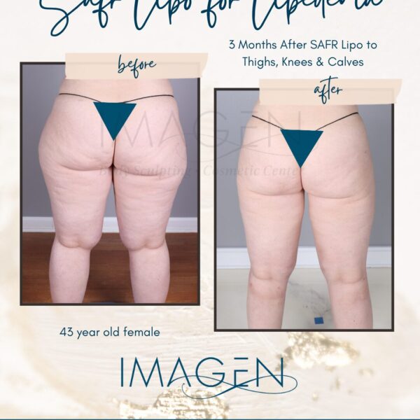 lipedema liposuction