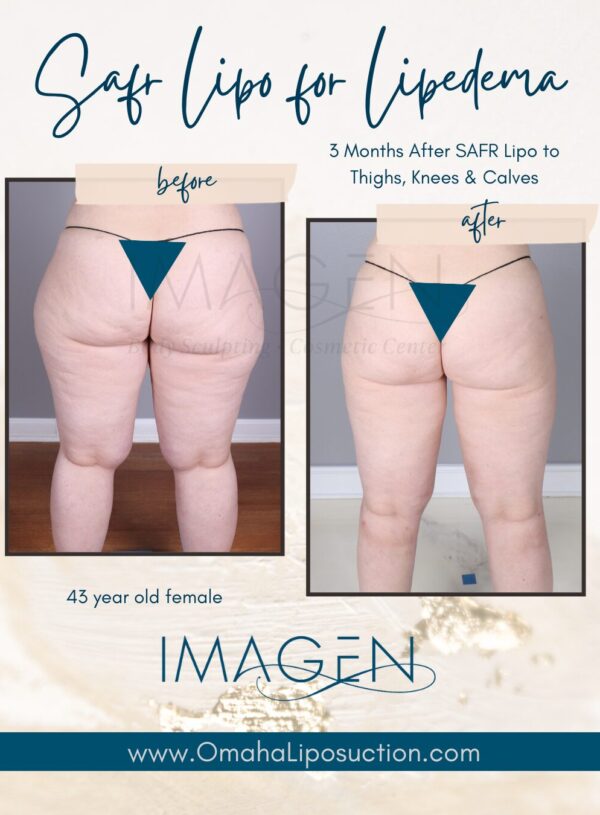 lipedema liposuction