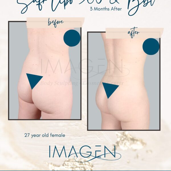 Ultrasound liposuction results omaha SAFR Lipo BBL