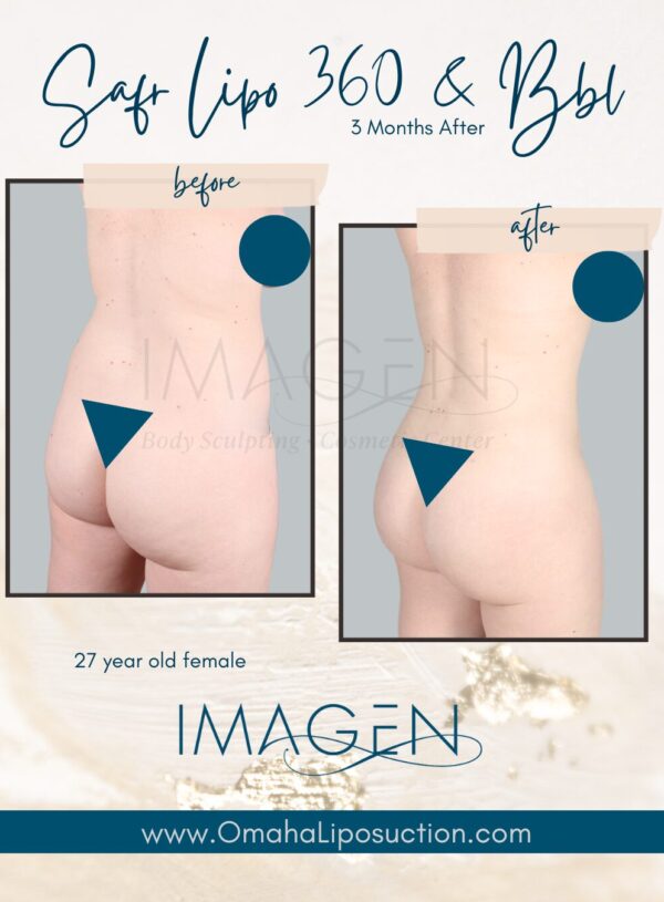 Ultrasound liposuction results omaha SAFR Lipo BBL