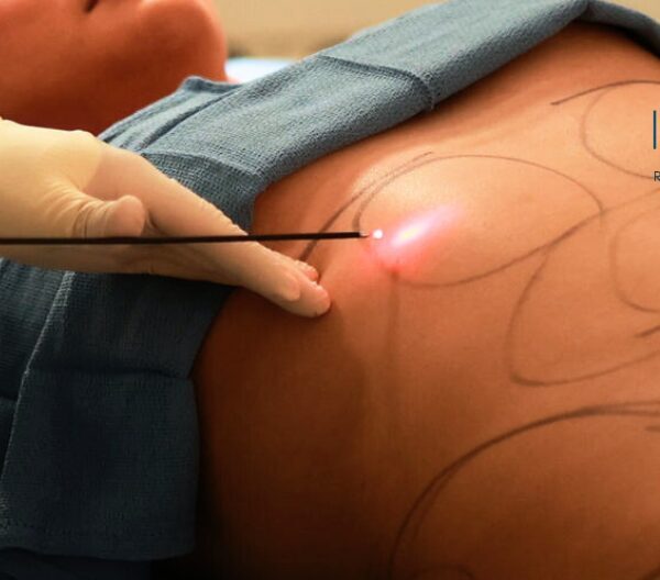 Cheap Liposuction in Omaha